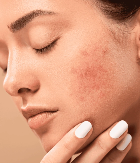 Składniki kosmetyczne wspomagające terapię trądziku